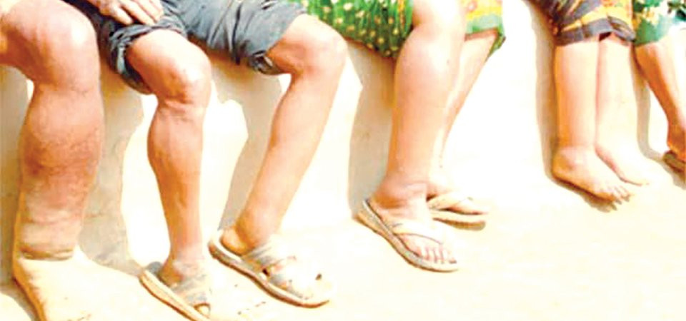 नेपालगञ्जमा हात्तीपाइलेविरुद्धको औषधि सेवन कार्यक्रम शुरू