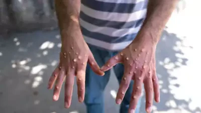 कंगोमा मंकीपक्सका कारण ६१० जनाको मृत्यु