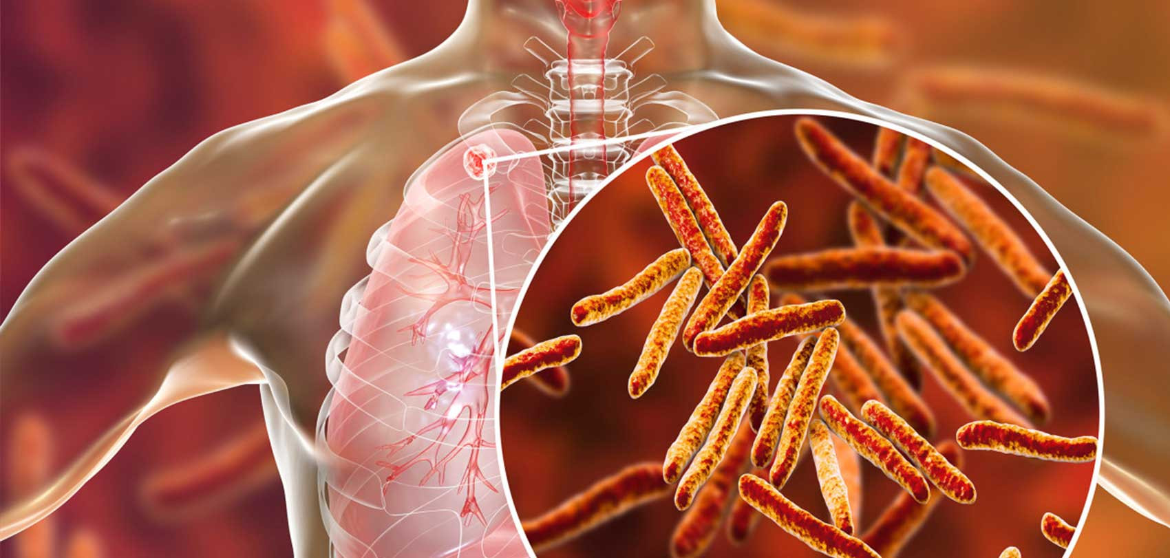 शङ्कास्पद क्षयरोगीलाई उपचारमा पठाउँदैन परिवार